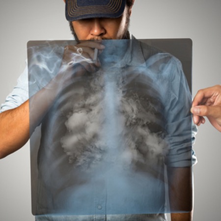 XRAY lungs of a man smoking a cigarette